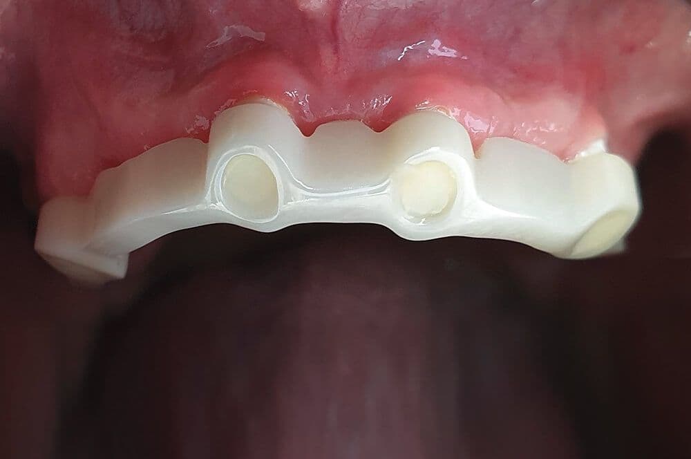 Abb. 1: Vier Zeramex XT Implantate in situ nach Einheilzeit. Extraktionsalveole 13 (gespiegelt) eine Woche post extractionem.
