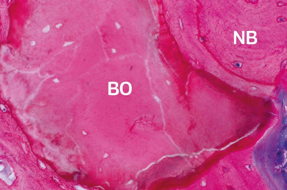Bio-Oss (BO), umrandet von neuem Knochen (NB) und Osteoid (O) am rechten seitlichen Bildrand (lila).