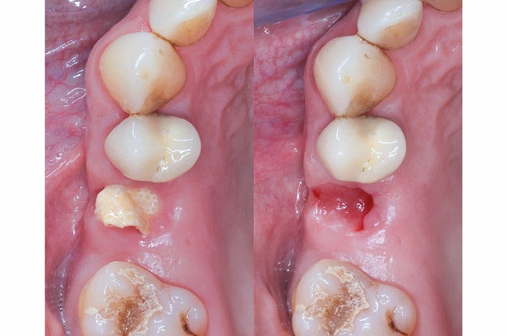 Abb 4: Die Situation vier Wochen postoperativ, Entfernung der PTFE-Membran und Blick auf das darunter regenerierte Gewebe.