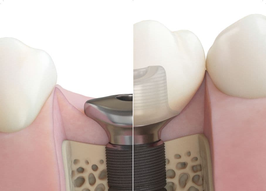 Dentsply Healing-Abutment