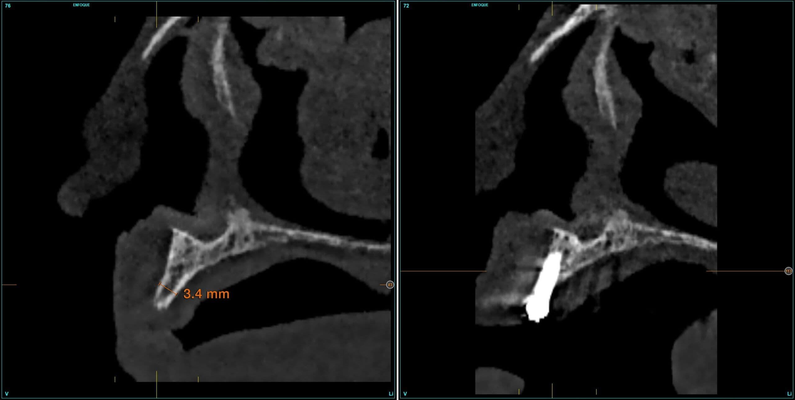Abbildung 30: Bilder der anfänglichen und abschließenden Vergleichsschnitte nach der Osseointegration und der progressiven Belastung der Implantate in den Bereichen mit stärkerer horizontaler Atrophie.
