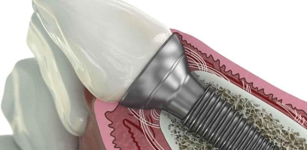 EAP Abutments