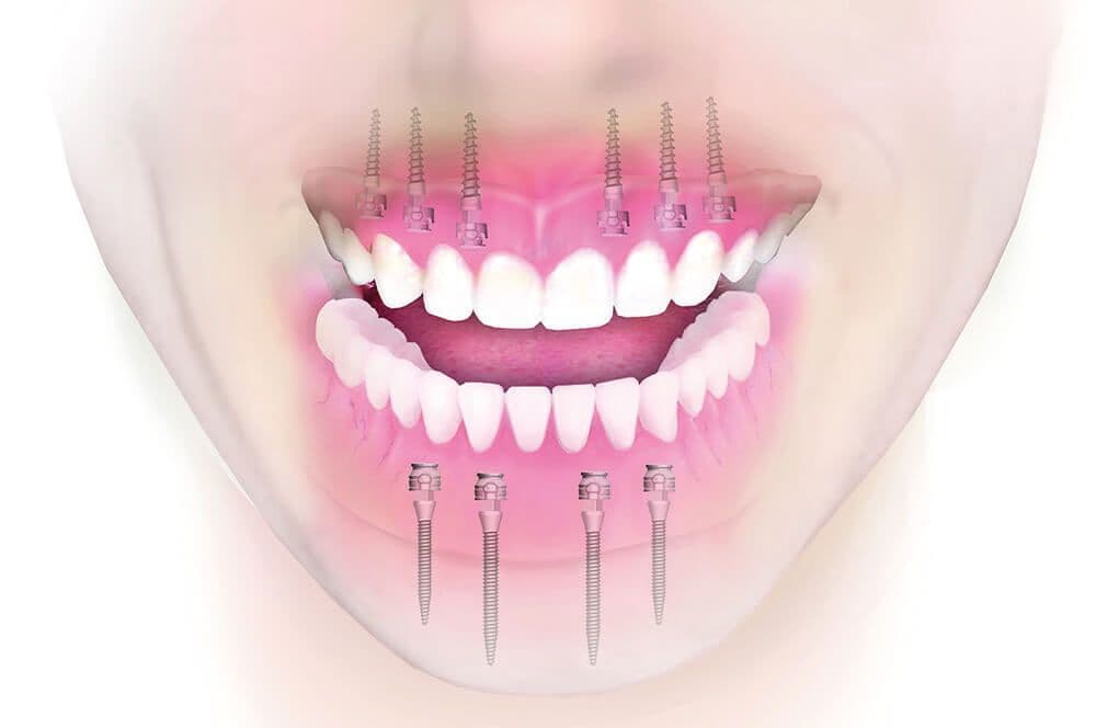 Mini-Implantate
