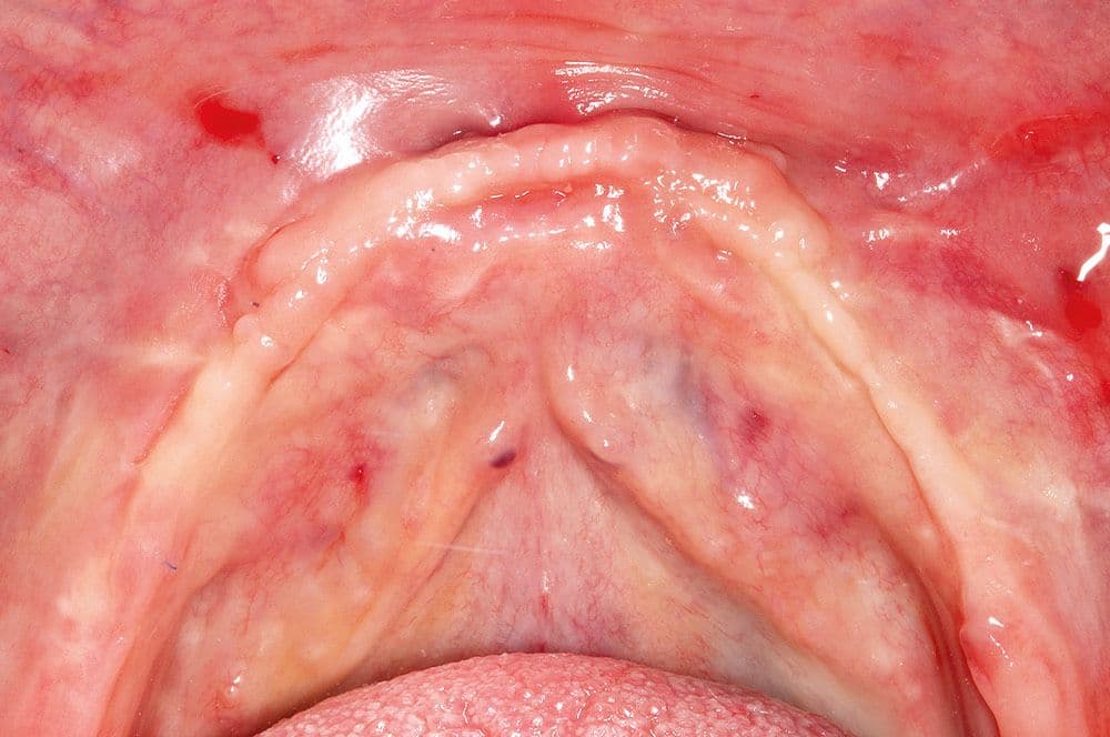 Zustand nach zehnmonatiger Einheilung, Biopsie quer am Alveolarkamm regio 32/33.