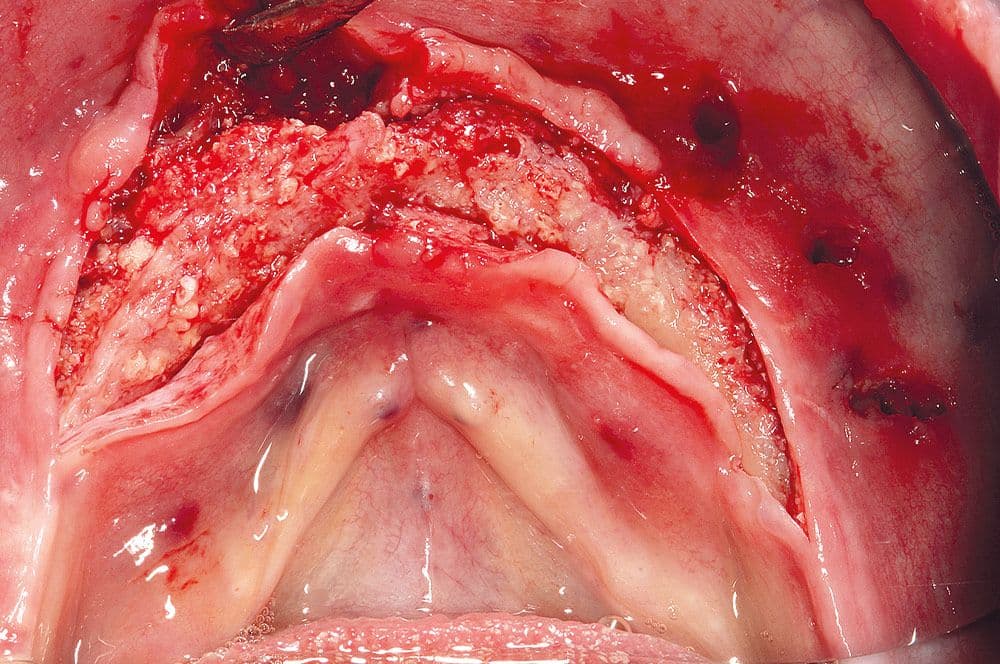 Klinischer Zustand nach erfolgreicher Augmentation, Entfernen der Schirmschrauben aus dem Bindegewebe.