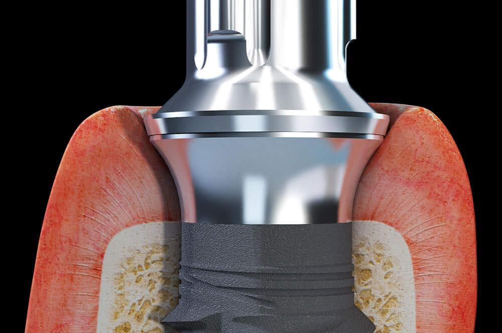 Tissue Level Implantate