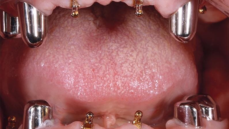 Miniimplantate Adjmal Sheerzoi