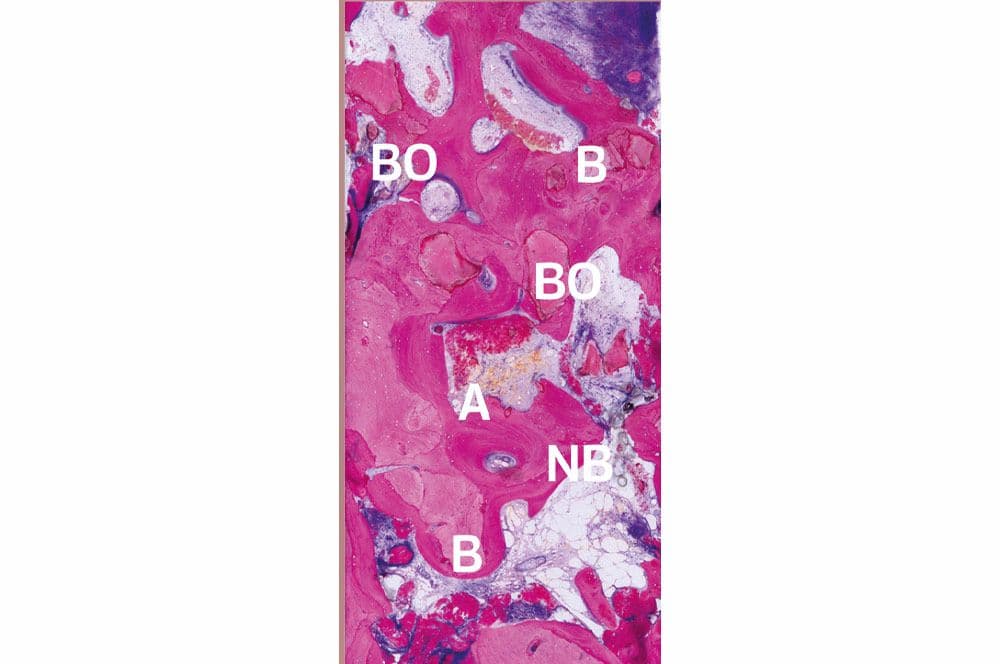 Bio-Oss (BO), Reste von älterem Knochen (B) in neu gebildetem Knochen (NB) und amorphem, kalzifiziertem Material (A), ...