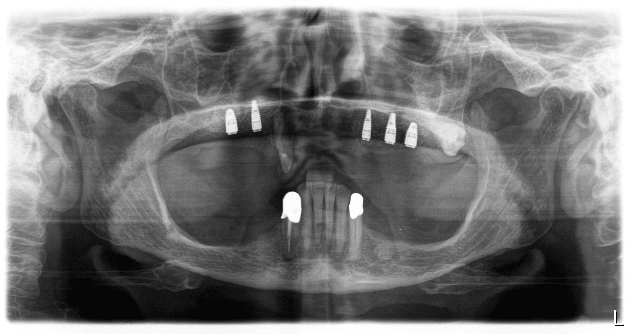 Postoperatives OPG nach Implantation.