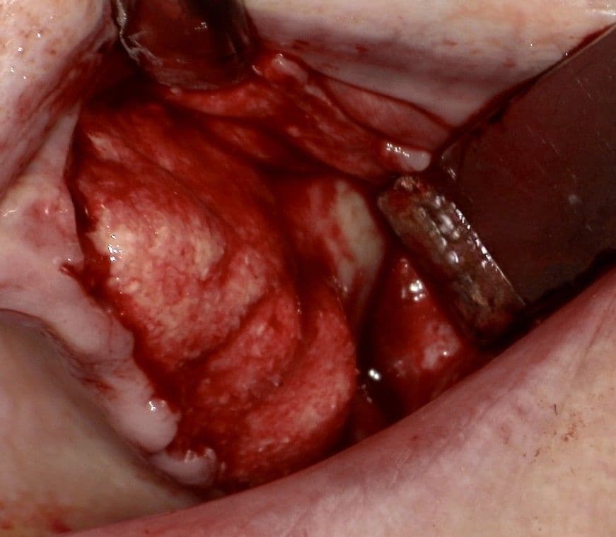 Durchführung der Ridge Preservation des II. Quadranten mit maxgraft®+HyA, hydriert mit PRF.