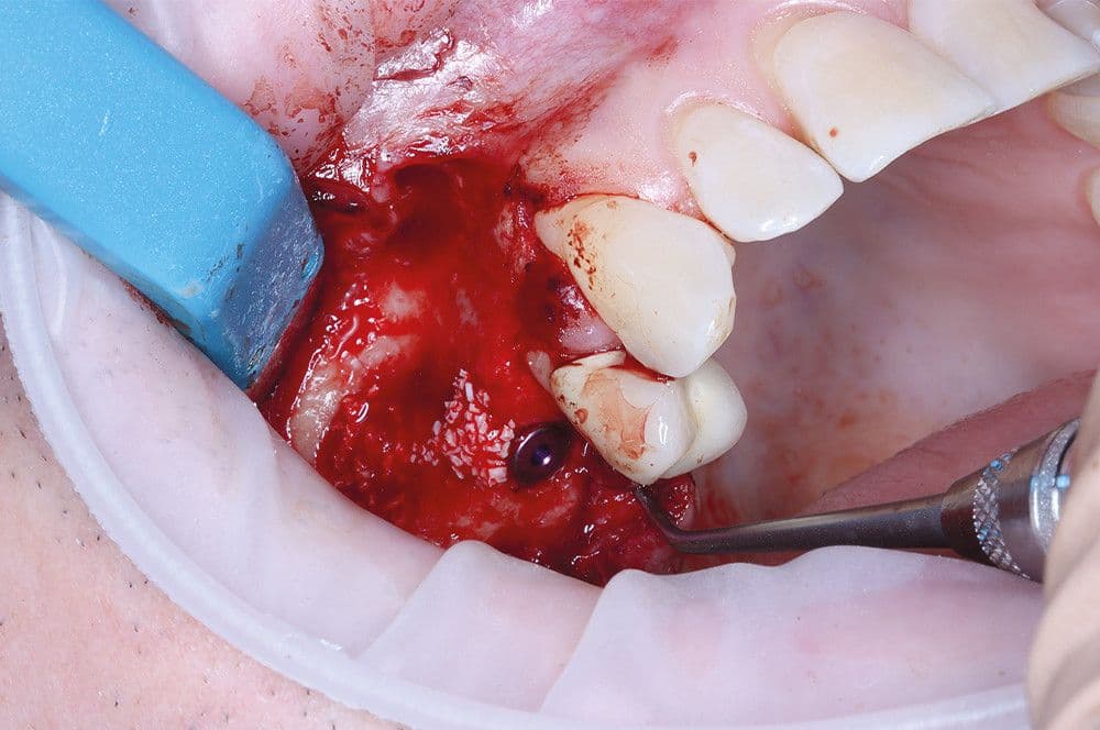 Abb 8: Das inserierte Implantat mit augmentiertem Sinus und aufgetragenem Knochenersatzmaterial.