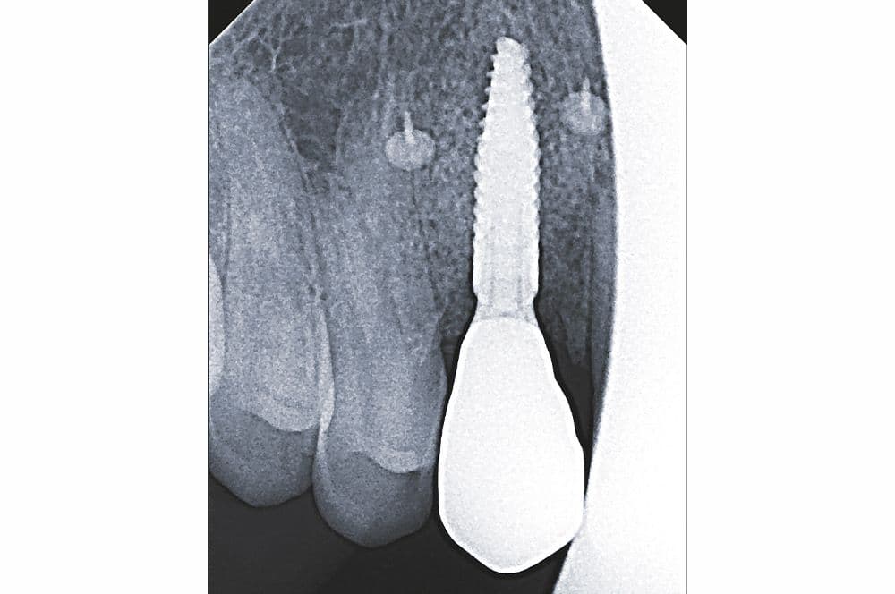 Das Röntgenbild zeigt die ausgezeichnete knöcherne Integration des Implantats mit stabilem periimplantären Knochenvolumen