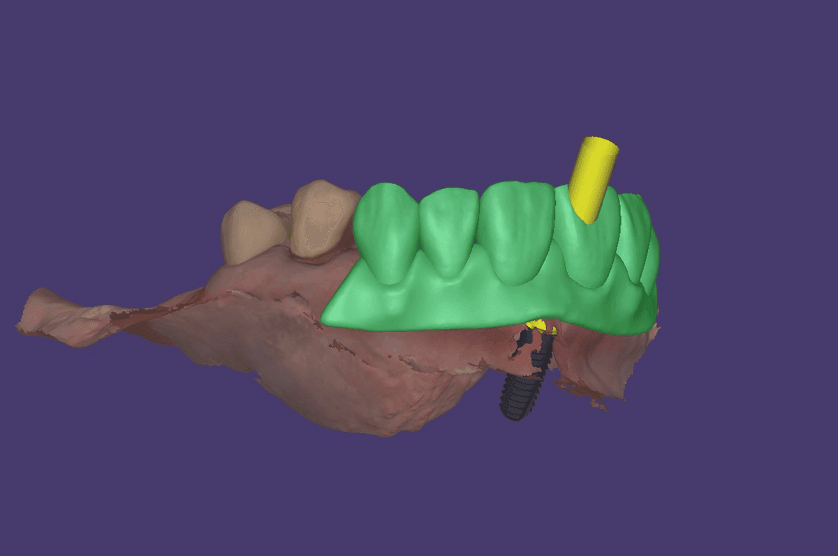 Fig. 12: Implantatplanung in exoplan – das Wax-up aus Smile Creator übertragen in exoplan zur Identifizierung der optimalen Implantatposition aus prothetischer Sicht.