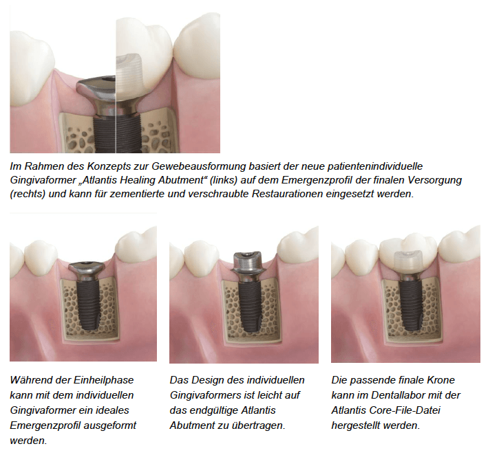 Atlantic Healing Abutment Dentsply Sirona