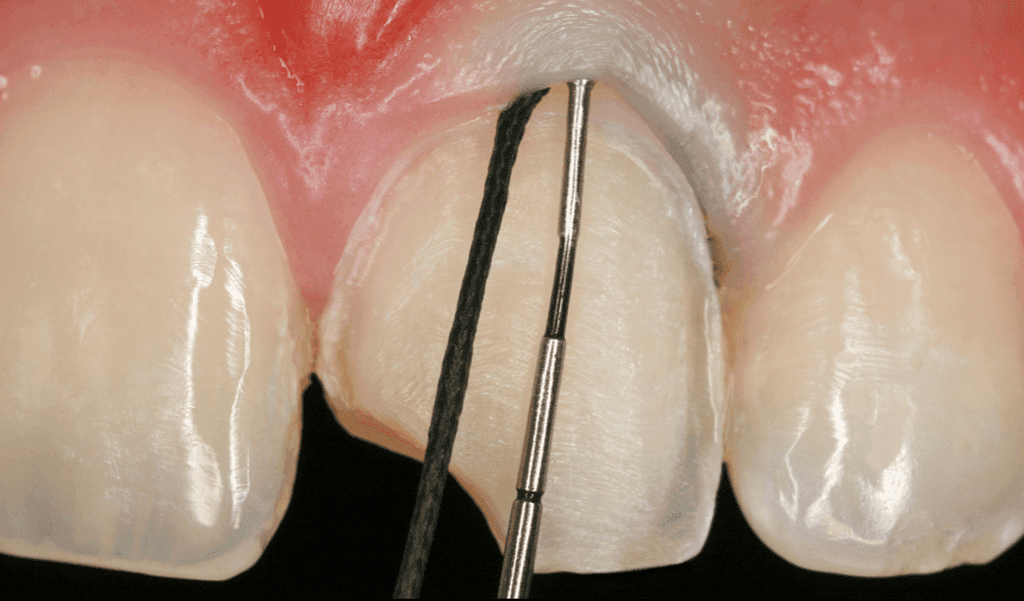 Cerec Masters