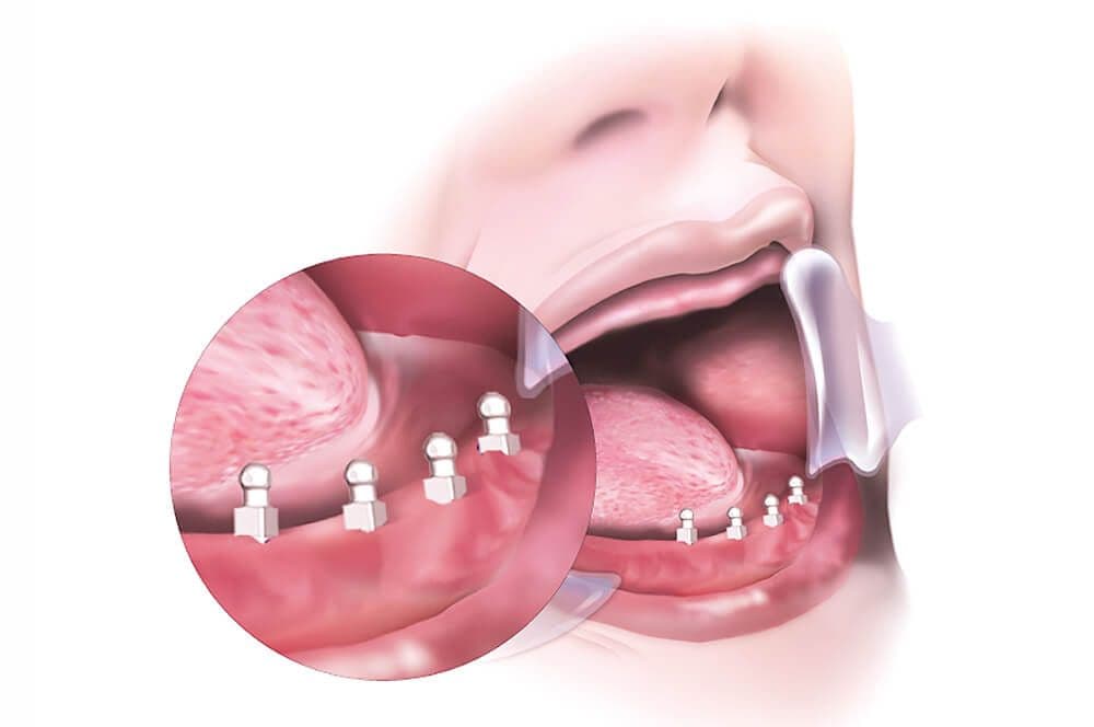 Mini-Implantate