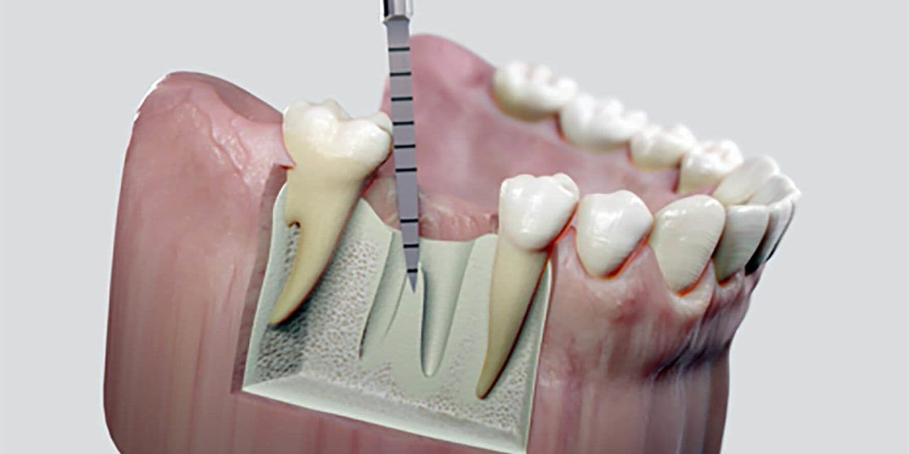 Sofortimplantationen1-1280×640