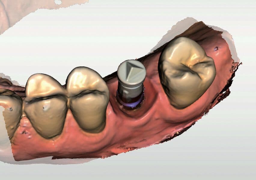 Cerec-Tag