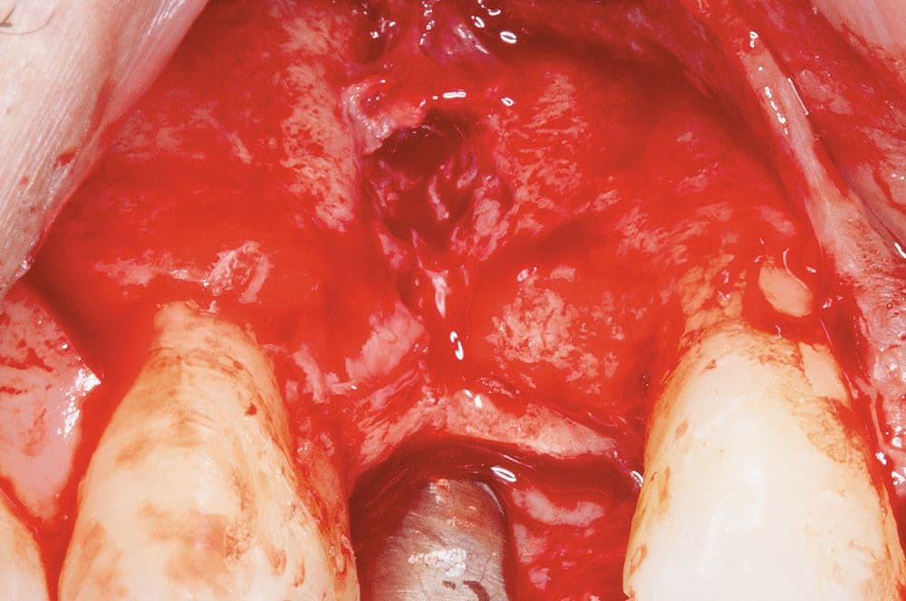 Ausgangssituation: Darstellung des Knochendefekts sechs Monate nach der retinierten Zahn- und Odontomentfernung