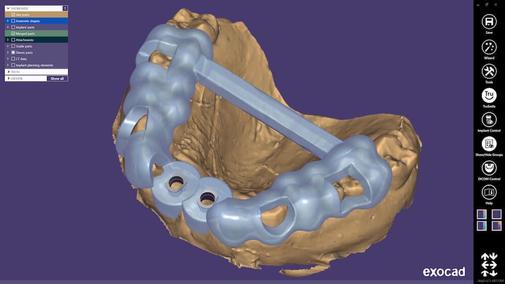 exocad_exoplan_Merged_Surgical_Guide_purple_EN