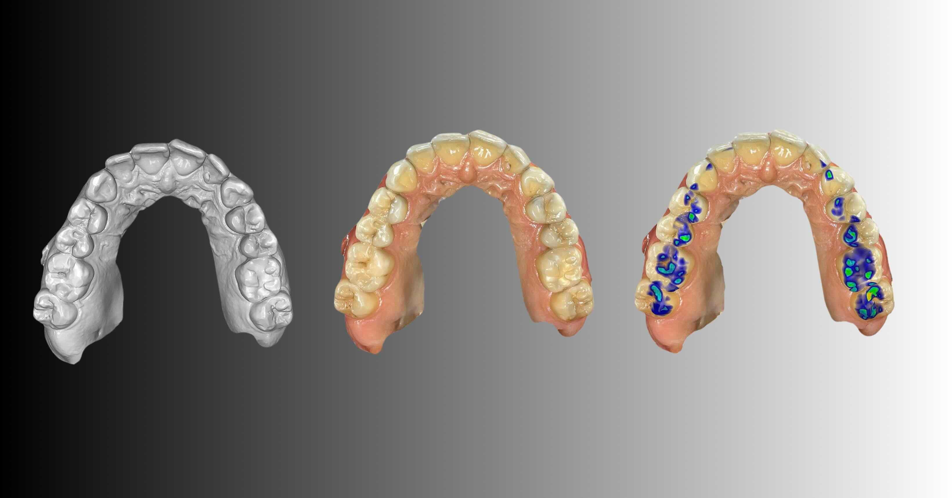 Drei Ansichten eines Oberkiefer-Intraoralscans nebeneinander: Graustufen-Rohscan, Scan mit natürlichen Zahnfarben und Scan mit farbiger Kariesdiagnostik-Überlagerung (blau/grün) an mehreren Zähnen.