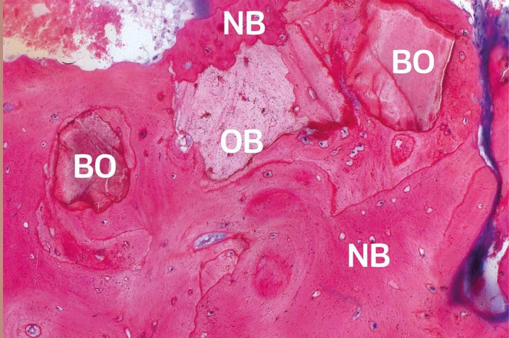 Remodellierter lamellarer Knochen (NB) grenzt nach zehn Monaten an Osteoid (O), umrandet von neu gebildetem Knochen.