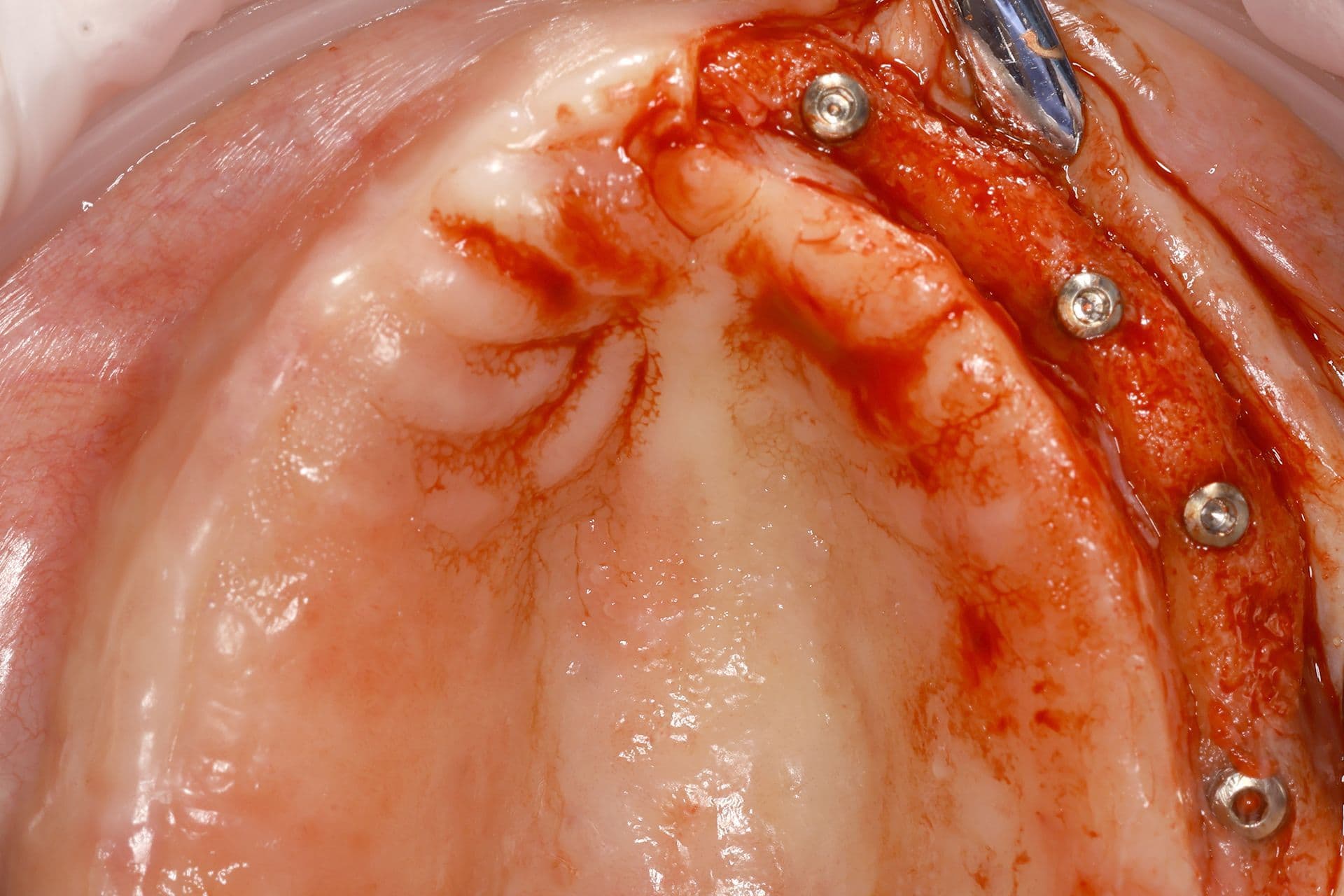Abbildung 25: Zweiter Eingriff, bei dem der hervorragende Zustand der Implantate und die durch die vorgenommene bukkale Überkorrektur gewonnene Breite zu erkennen sind. Gleichzeitig ist eine Verdickung des den Kieferkamm bedeckenden Weichgewebes erkennbar.