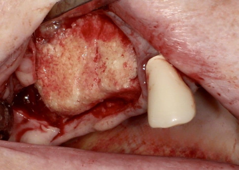 Augmentation des I. Quadranten mit maxgraft®+HyA, hydriert mit PRF.