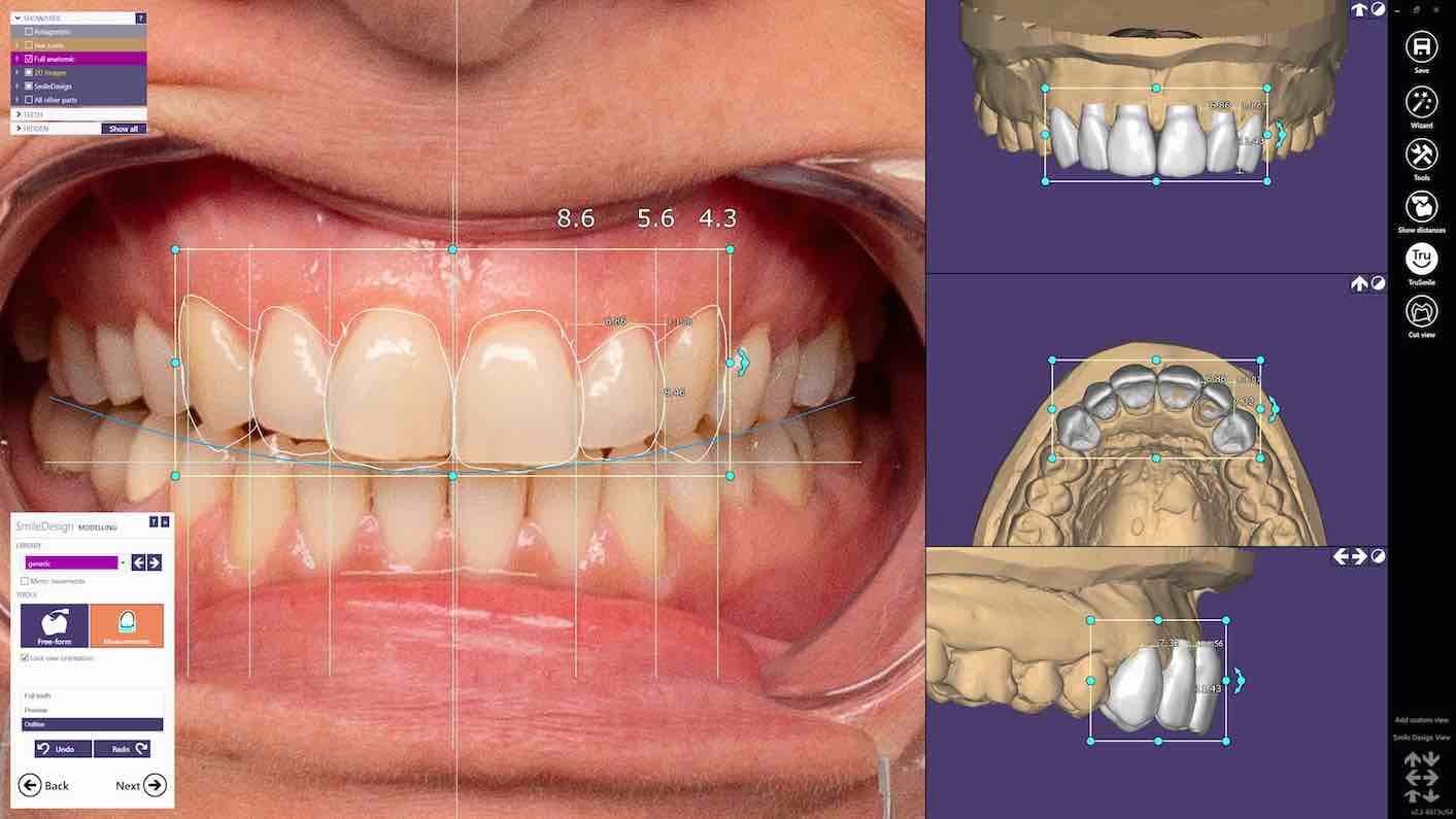exocad_Smile Creator