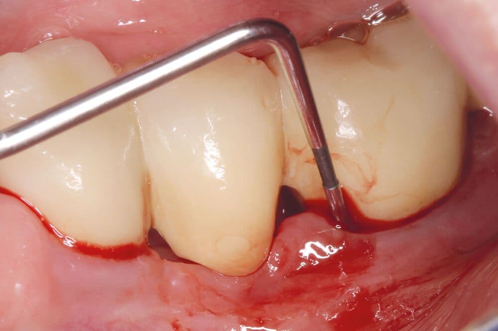 Abb 1: Klinische Ausgangssituation an Implantat 36: ST 7 mm, BOP+.