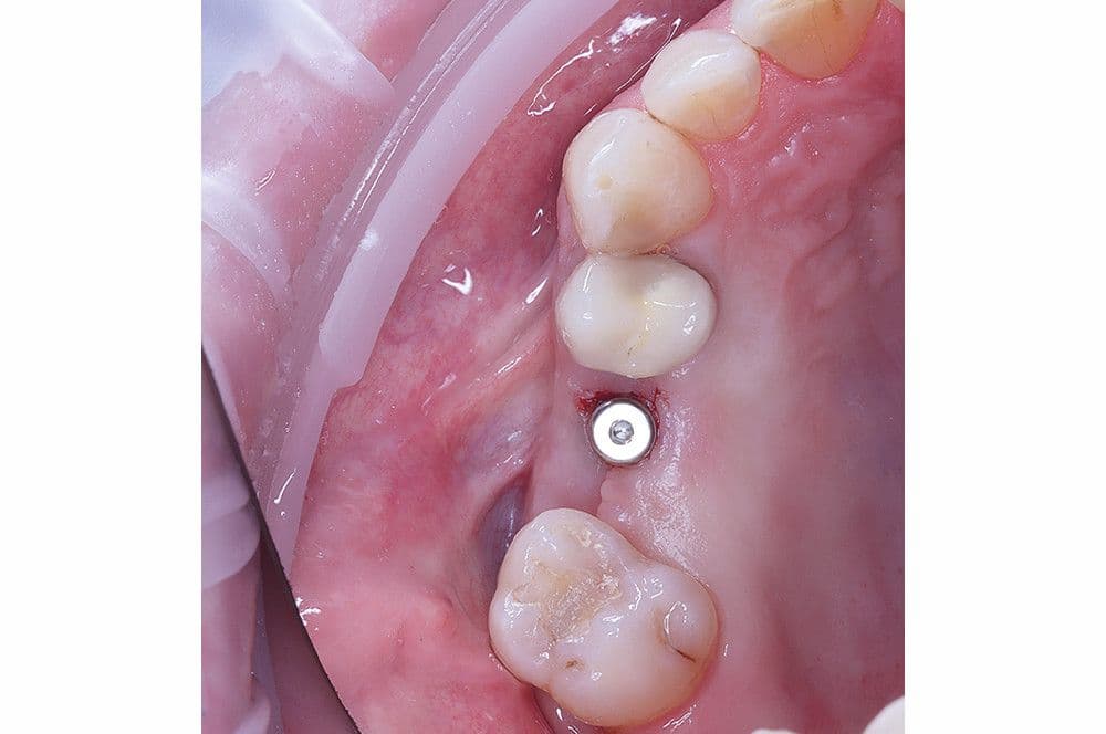 Abb 12: Eingesetzter Gingivaformer nach minimalinvasivem Zugang zur Implantatverschlussschraube.