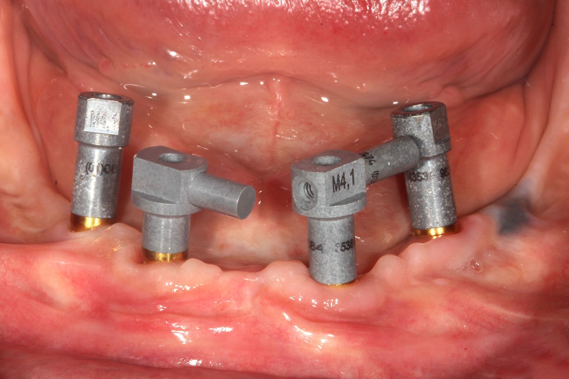 Abbildung 35: Auf den transepithelialen Abutments aufgeschraubte Scanbodies zur Anfertigung eines Intraoralscans.