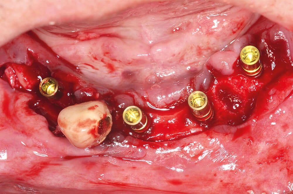 3. Intraoperative Ansicht bei der Implantation (Camlog Screw-Line Promote, Camlog) in regio 34, 32, 42 und 44.