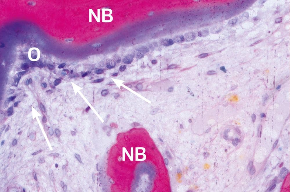 Am neuen Knochen (rosa) hat sich Osteoid gebildet (Pfeile), welches am Rand durch Osteoblasten (lila Kreise) gesäumt wird.