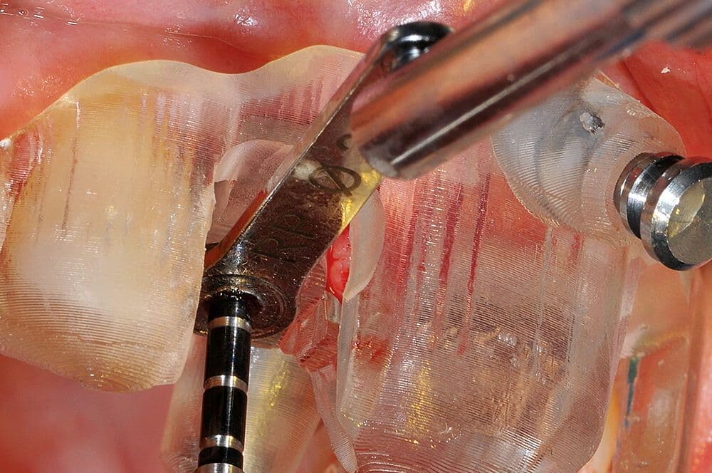 Implantatrekonstruktion