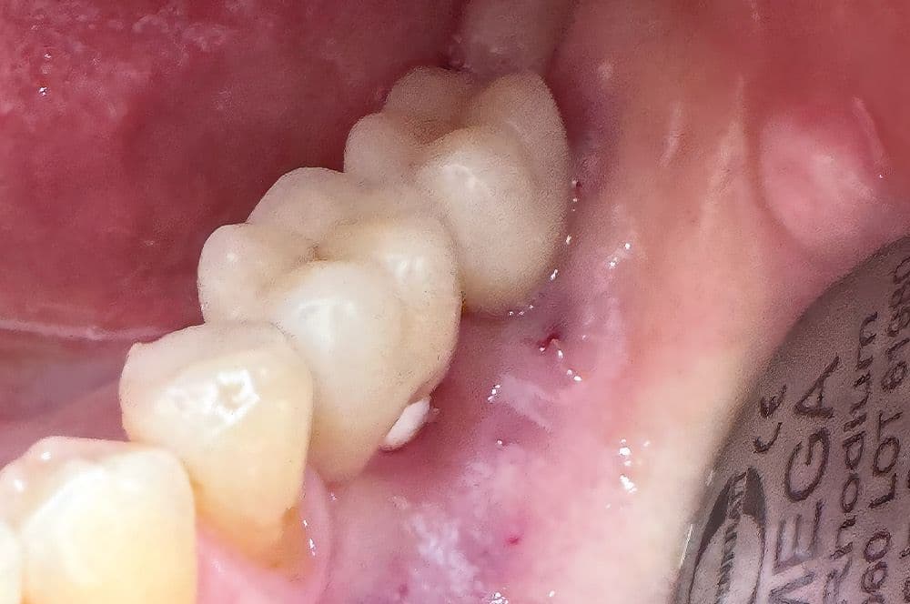 Abb.-01-Intraorale-Ansicht-der-linken-mandibulaeren-Molarenregion-mit-deutlich-reduzierter-keratinisierter-Gingiva.jpg