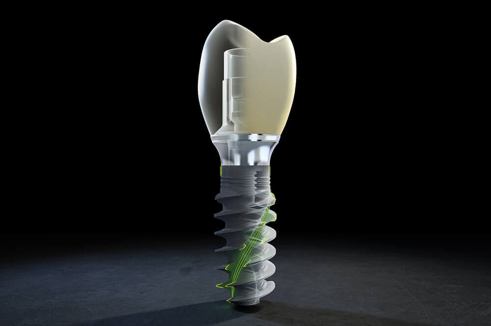 Tissue Level Implantate