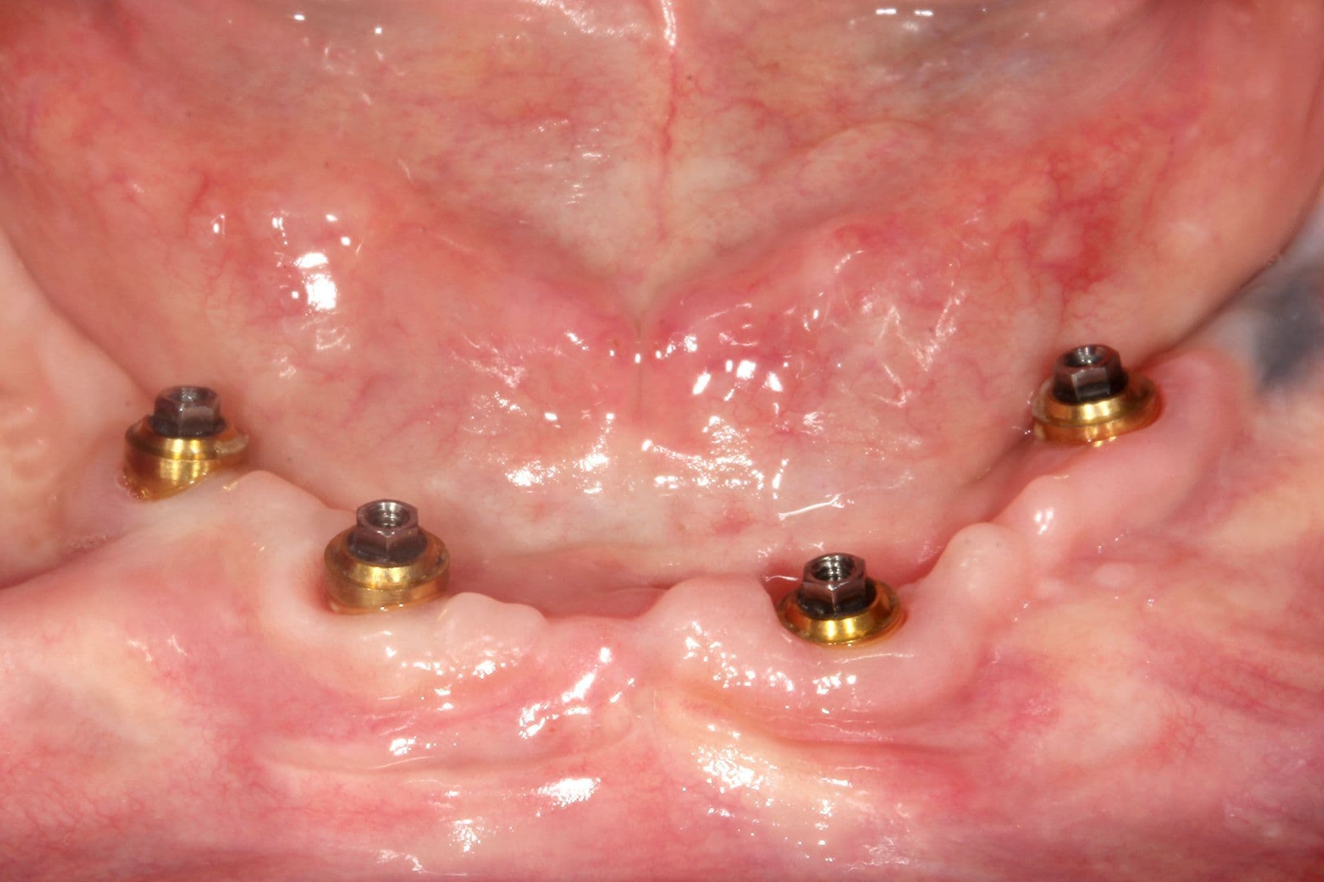 Abbildung 32: Bilder der anfänglichen und abschließenden Vergleichsschnitte nach der Osseointegration und der progressiven Belastung der Implantate in den Bereichen mit stärkerer horizontaler Atrophie.