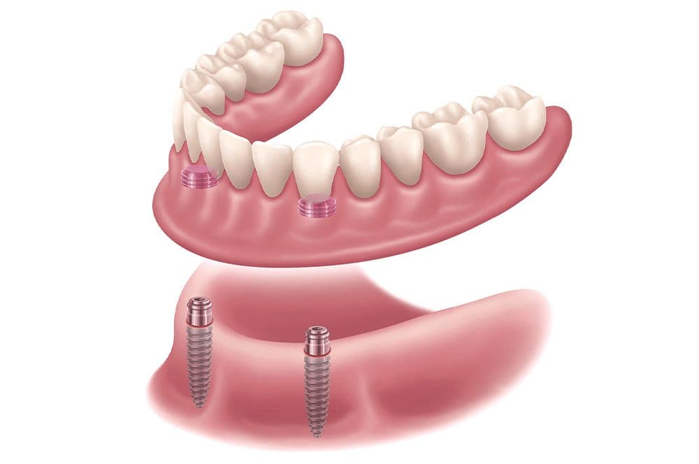 Locator Attachment