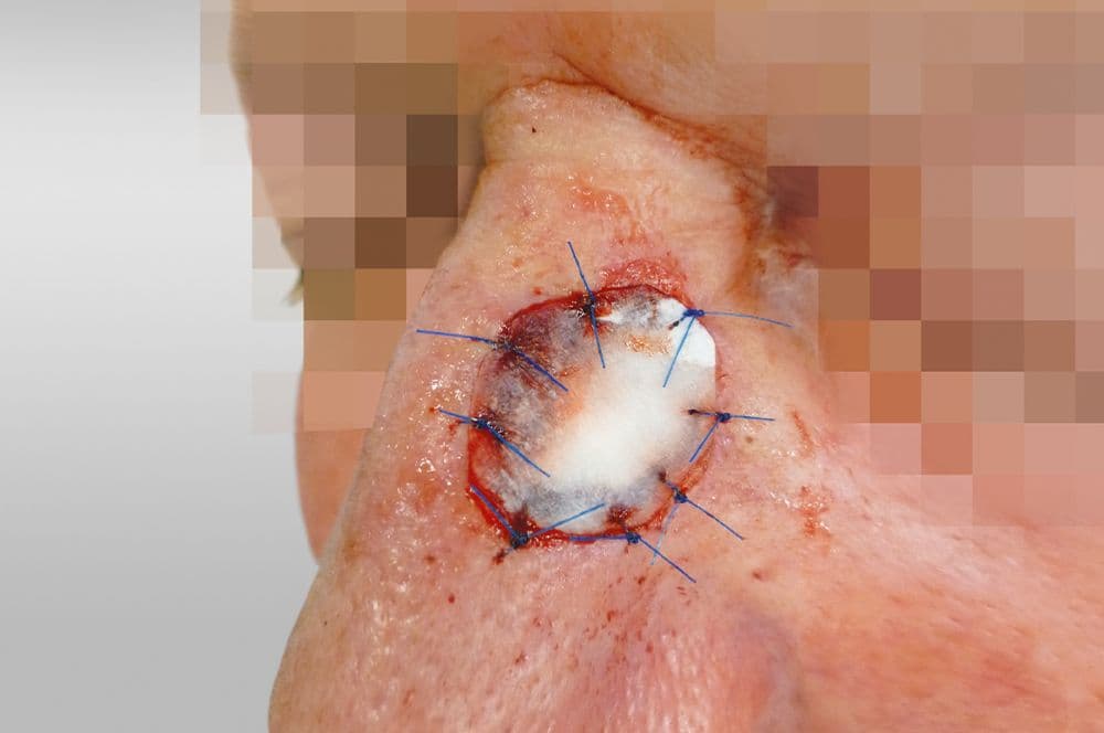 Mucograft