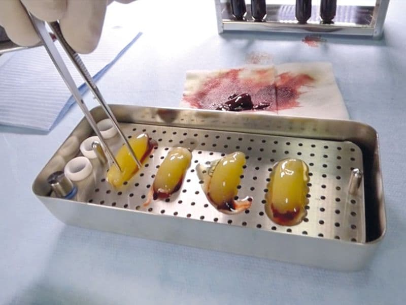 Platelet-Rich-Fibrin
