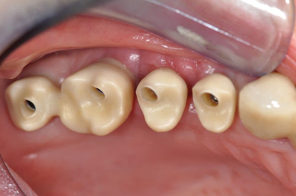 Ultrakurze Implantate im Molarenbereich