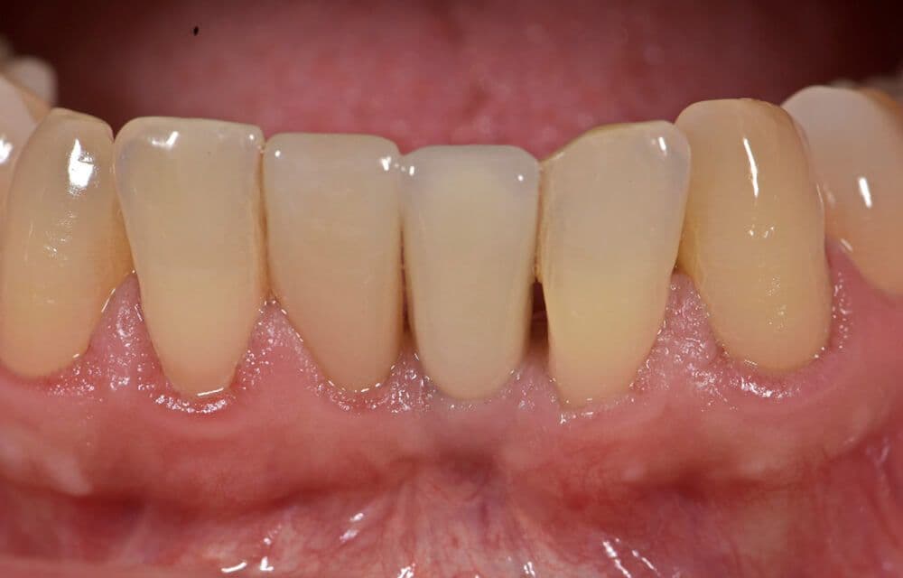 Abb. 15 Die Papillen und die zervikale Gingiva sind nach fünf Jahren maturiert, stabil und entzündungsfrei.