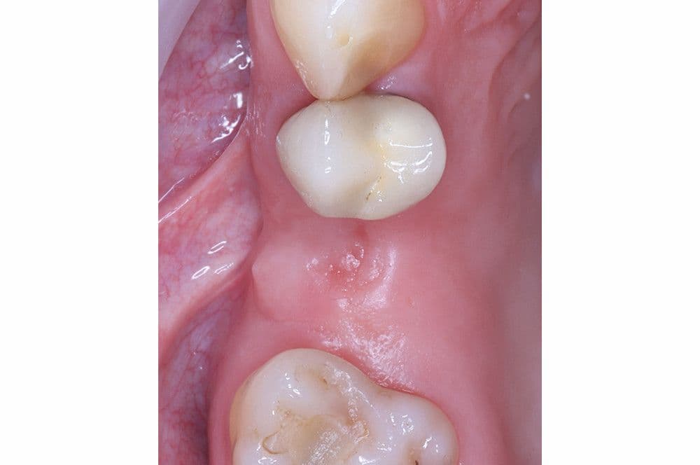 Abb 6: Die intraoperative Situation unmittelbar vor Implantation.