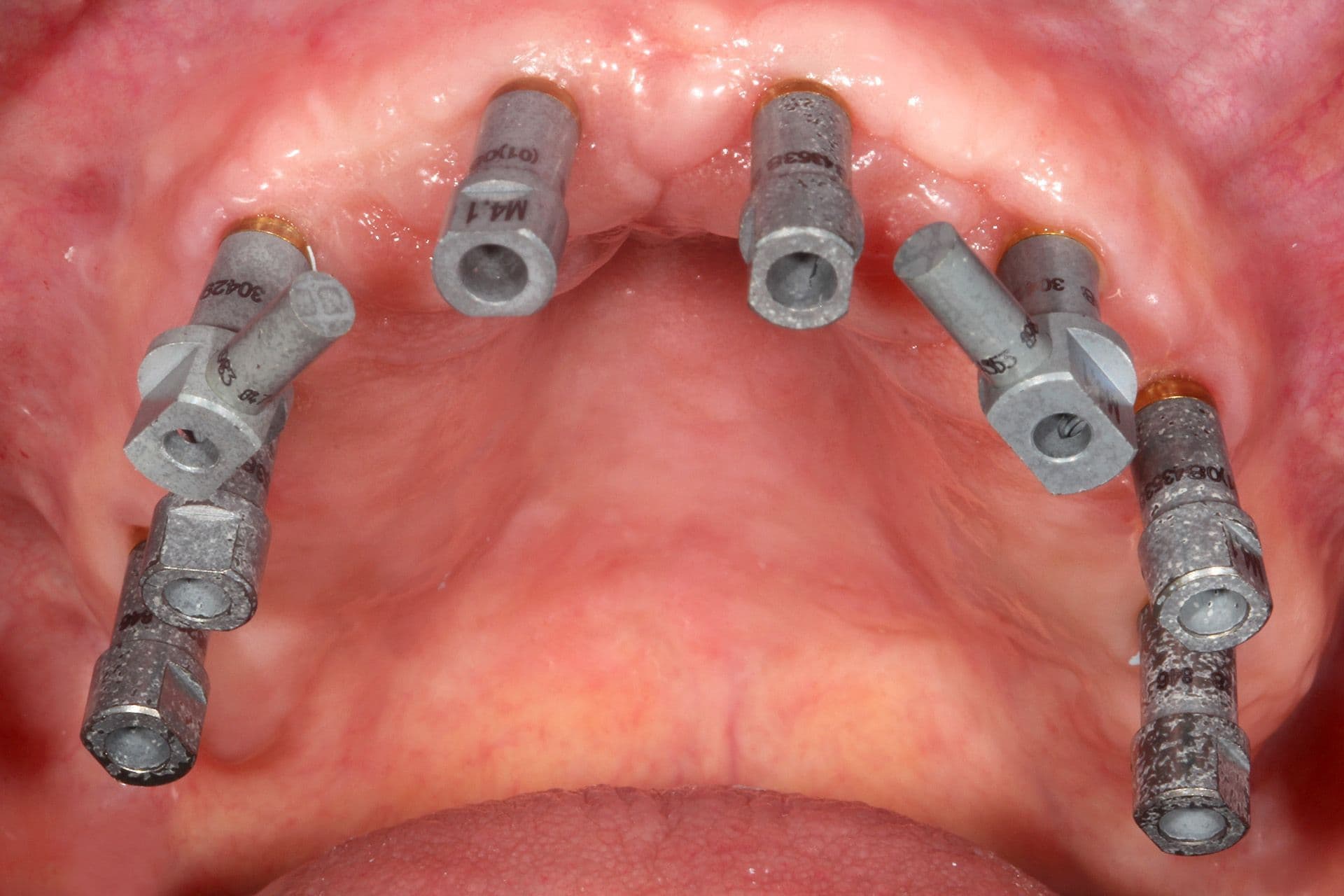 Abbildung 34: Das periimplantäre Weichgewebe zum Zeitpunkt der Abformung für die definitive Versorgung.