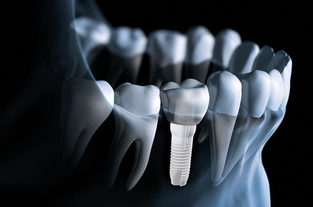 Z5-Reihe, Z-Systems, Bone-Level-Implantat, Tissue-Level-Implantat