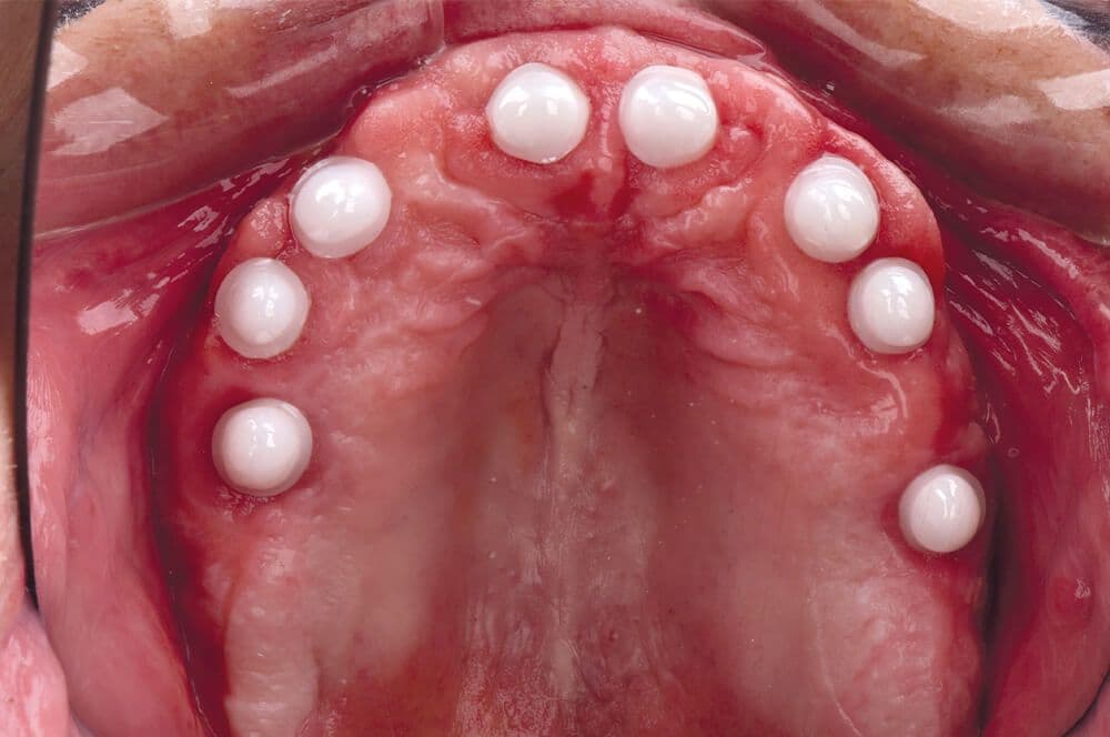 Abb1: Reizlos eingeheilte Implantate mit aufgesetzten Primärteilen.