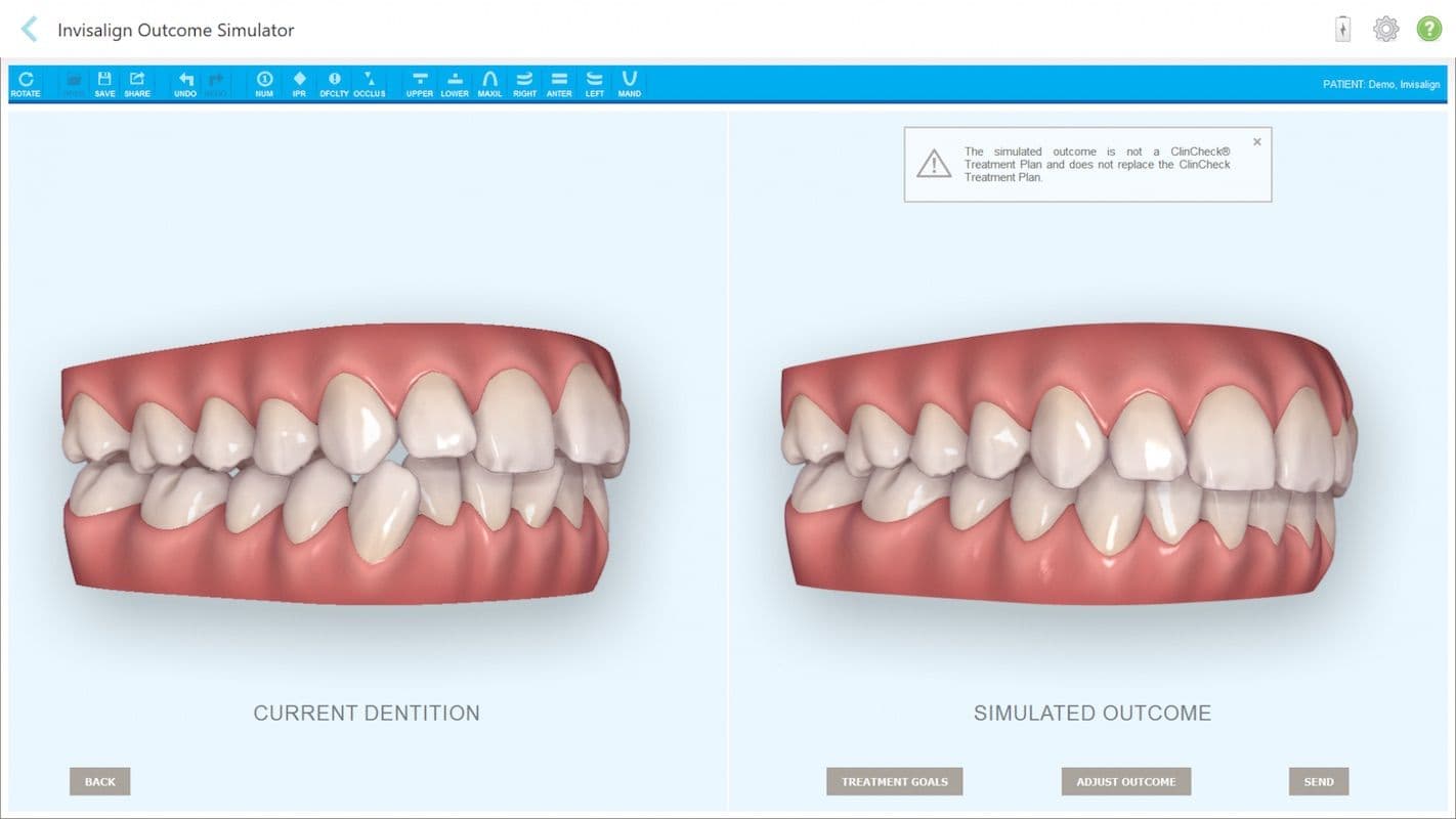 Invisalign Outcome Simulator Screenshot