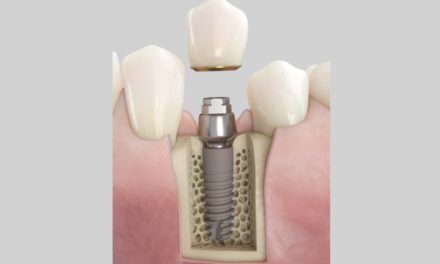 Dentsply Sirona Implants lanciert Acuris