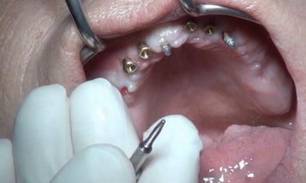 Video: Klinische Studie BEGO Semados Mini Easy Con Provisorisches Implantat